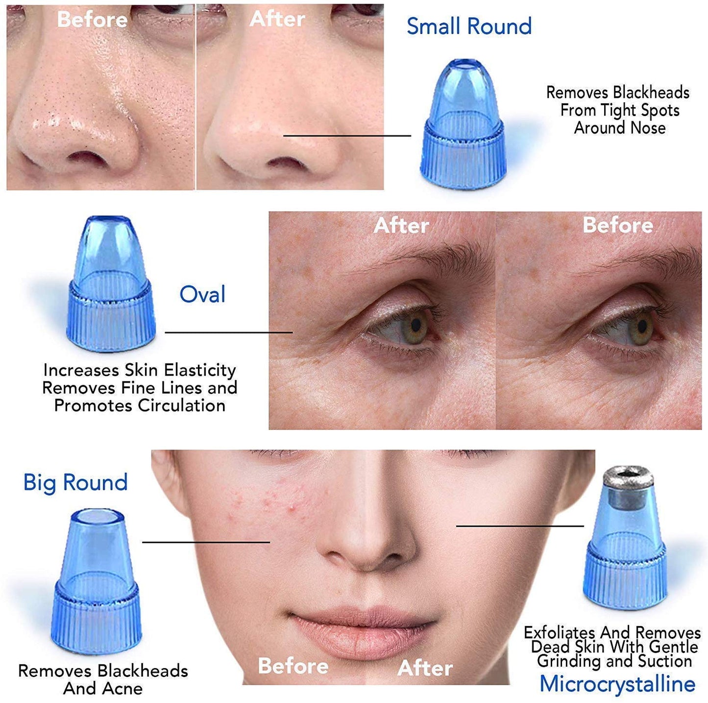 🌟 BuBu PoreAway Pro – Blackhead Remover Vacuum with 4 Suction Heads