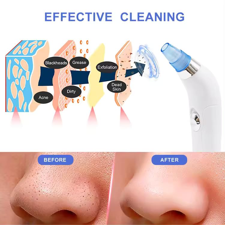 🌟 BuBu PoreAway Pro – Blackhead Remover Vacuum with 4 Suction Heads
